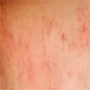 Eczema Icon